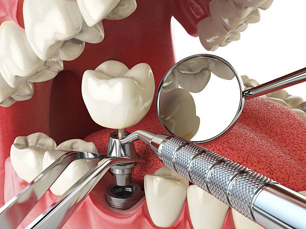Best Emergency Tooth Extraction in Phelan, CA